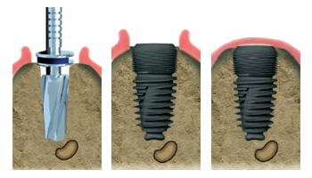 implant dentiste le havre implant dentiste le havre