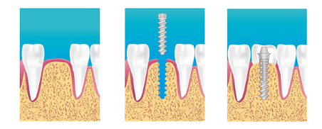 implant centre dentaire le havre